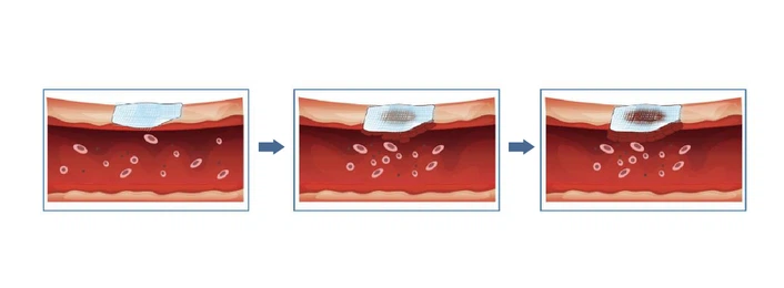 Hemostatic-Dressing Hemostatic-Dressing